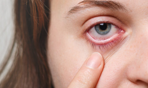 Doenças da superfície ocular: o que são, quais são e como prevenir